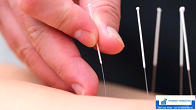 Acupuncture