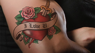 Tattoo Removal